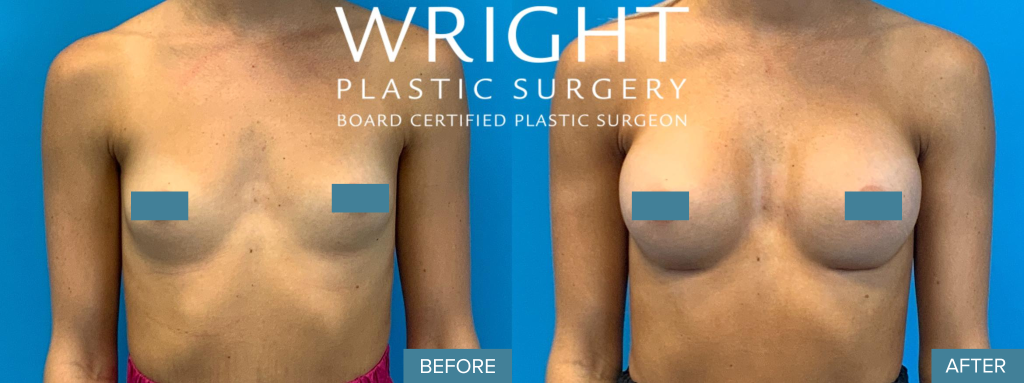 Breast Augmentation Before and After