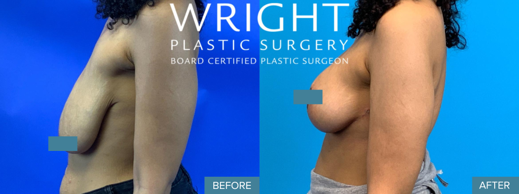 Breast Lift Before and After