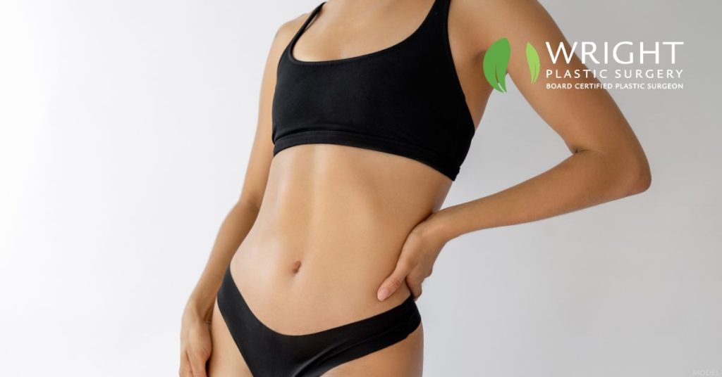 Woman posing post tummy tuck (model)