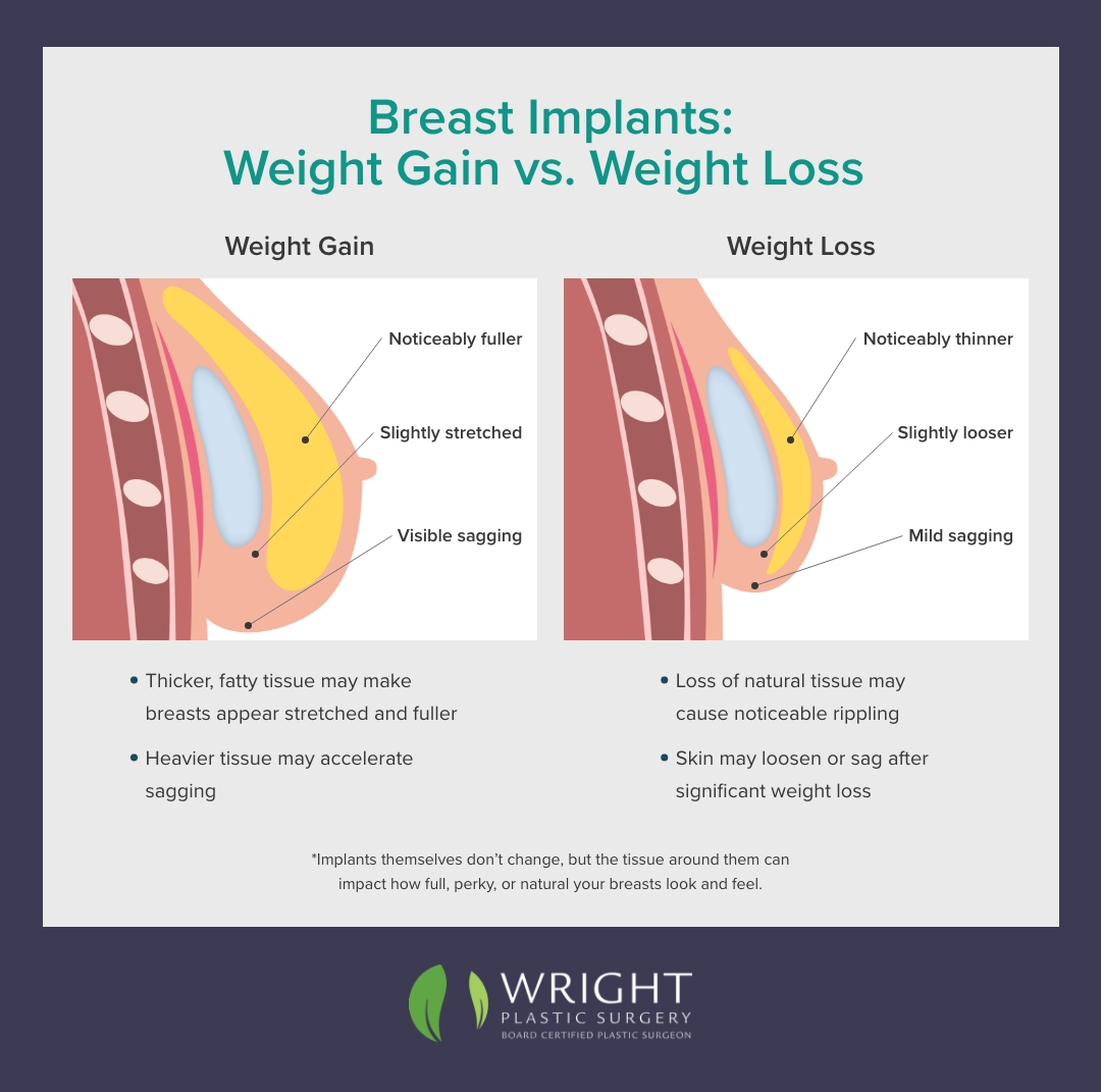 Breast implants: weight gain vs weight loss infographic.