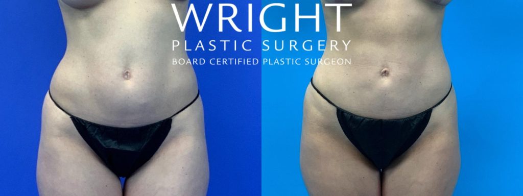 Before and after image of the results of a tummy tuck with Dr. Wright.