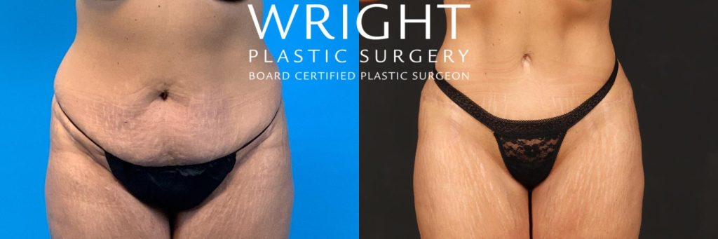 Before and after image showing results of a tummy tuck with liposuction.