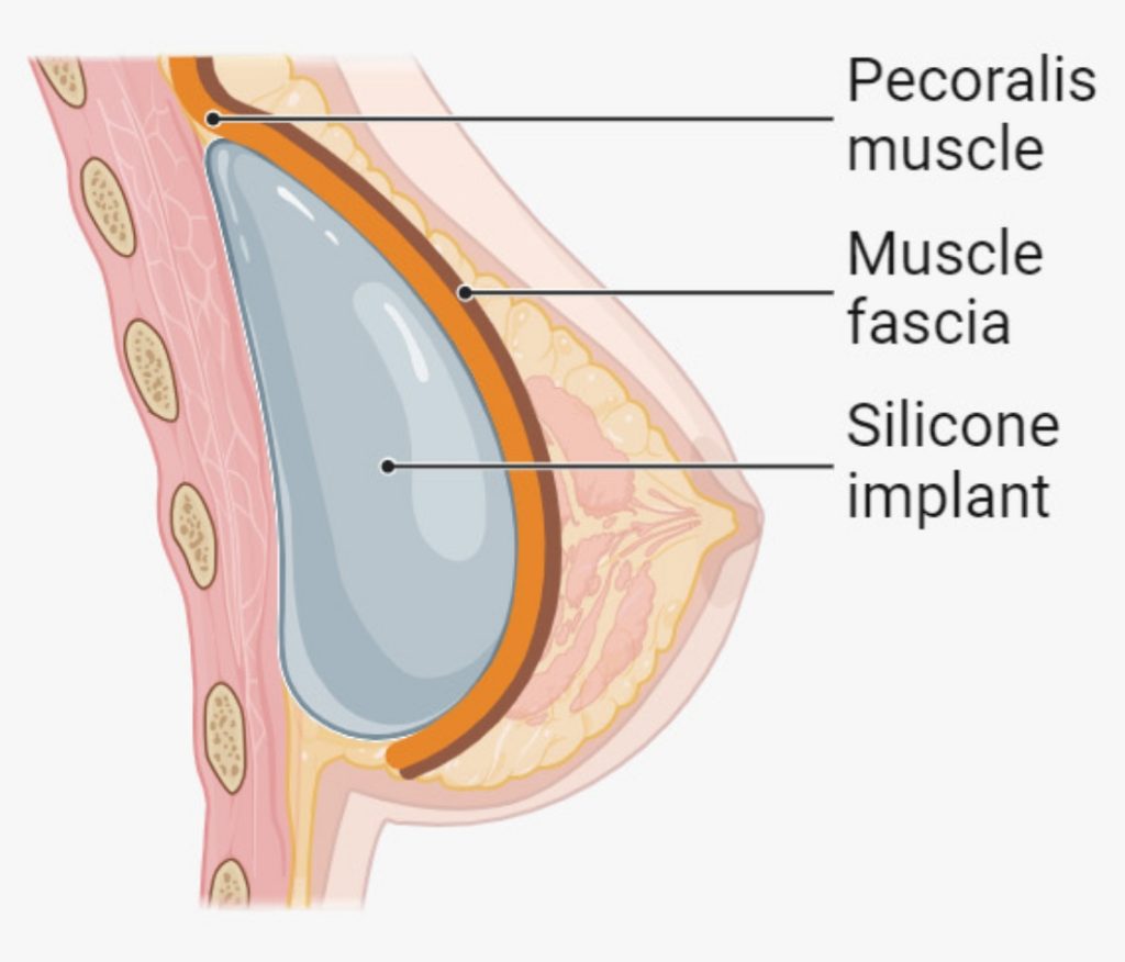 Submuscular
Implant fully under pectoralis muscle