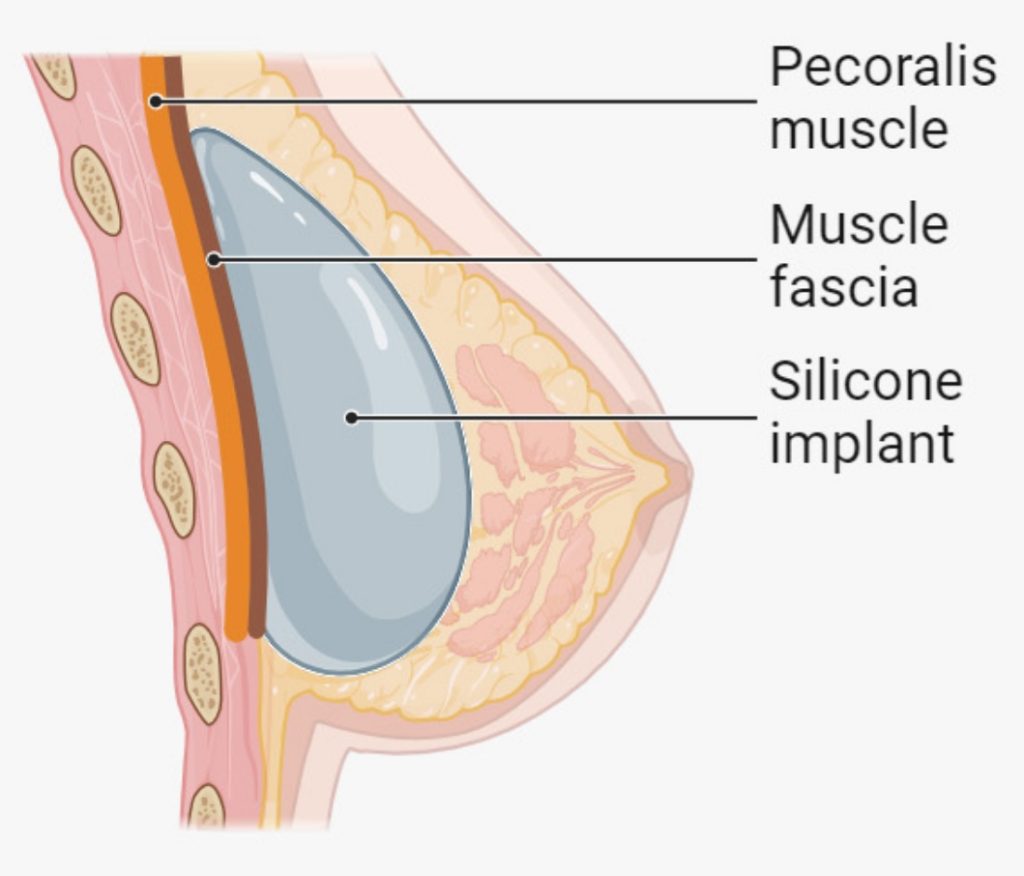 Subglandular
Implant on top of pectoralis muscle