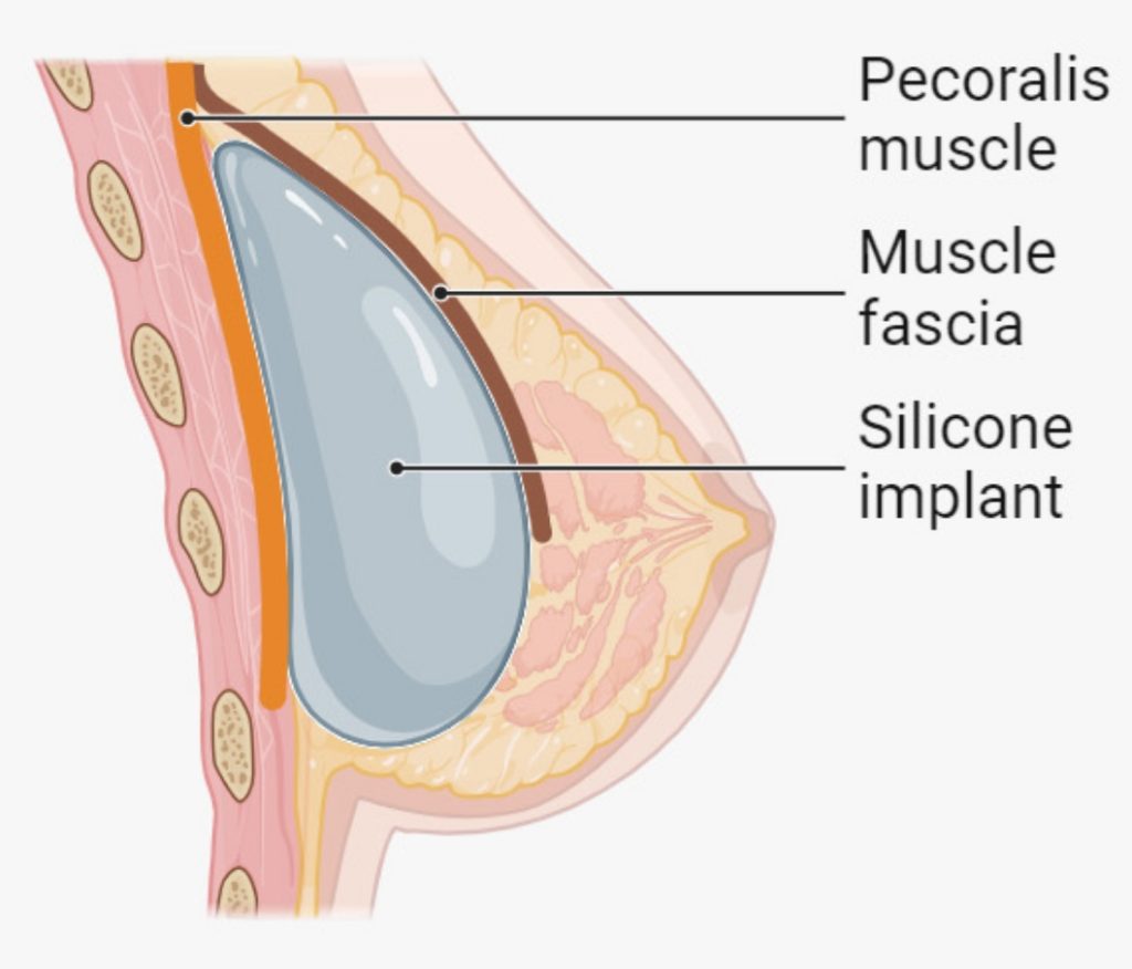 Subfascial
Implant under muscle fascia, but over muscle