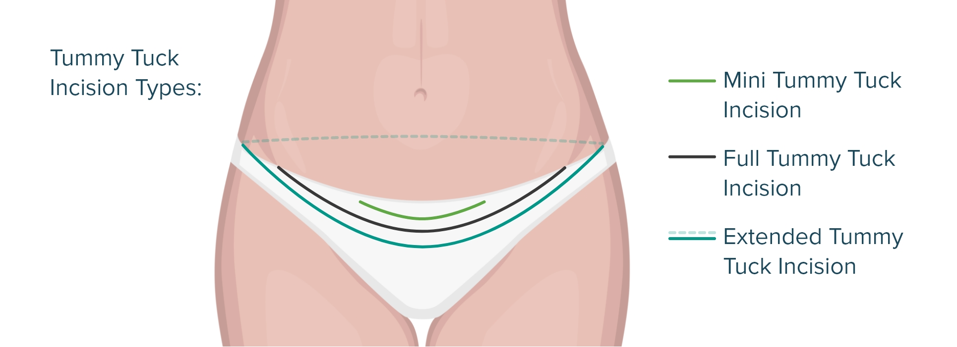 Tummy Tuck Incision Types